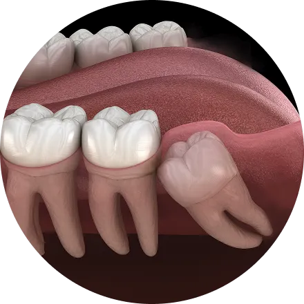 即日抜歯・複数本同時抜歯も対応
