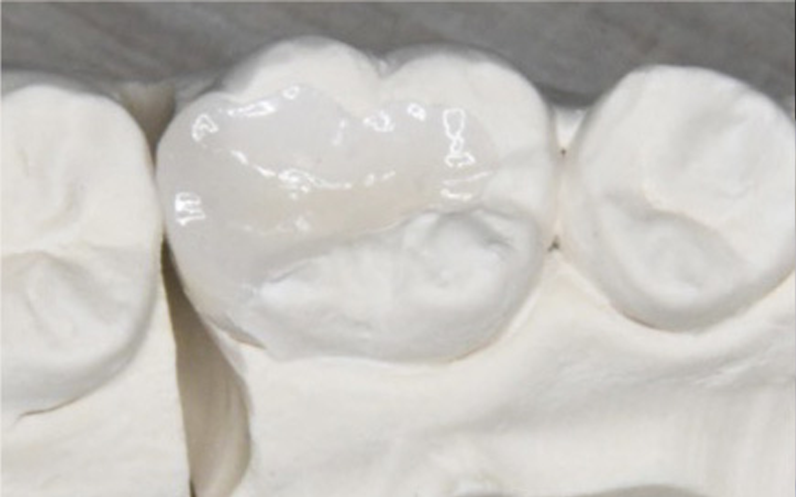 セラミックインレー