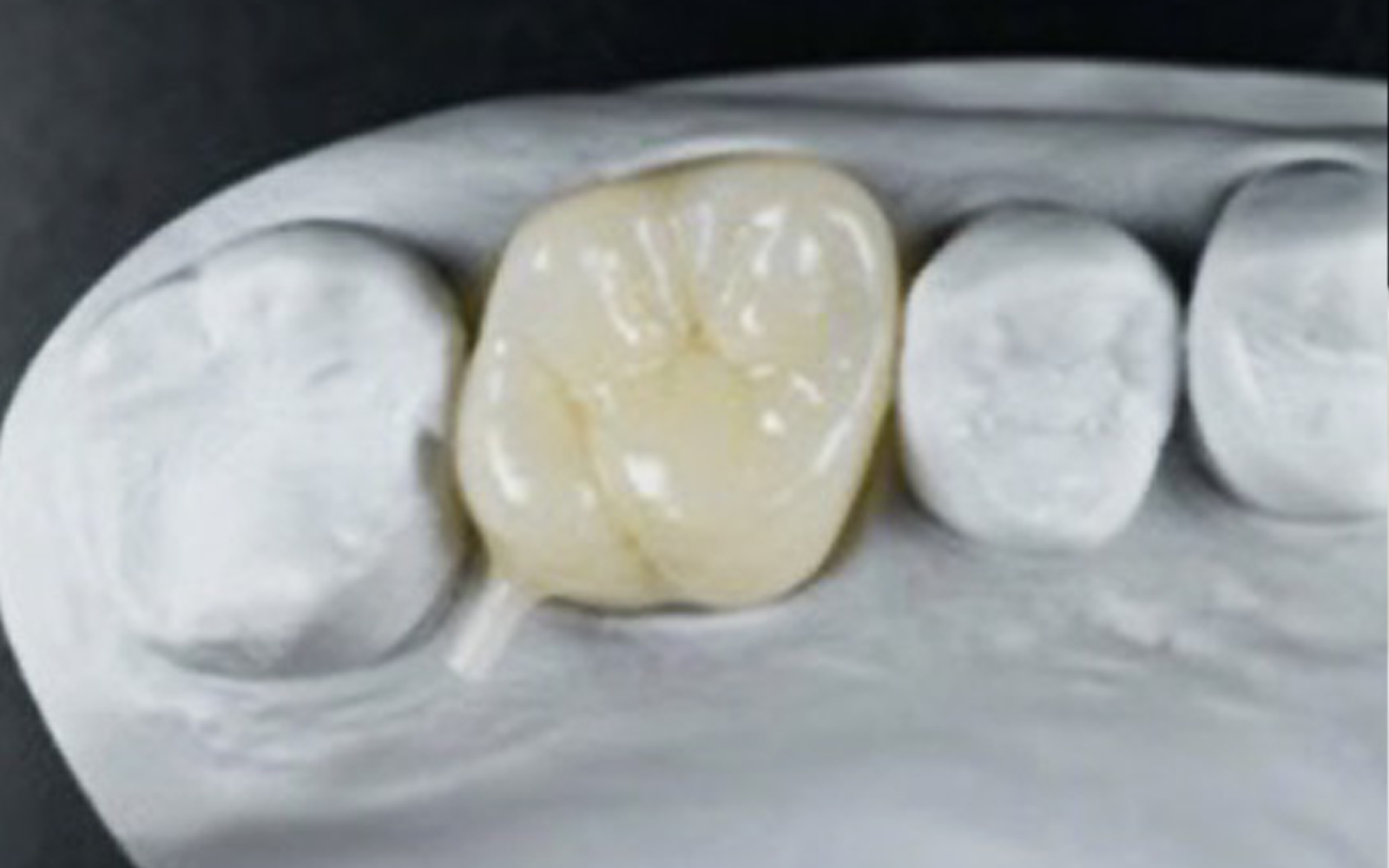 オーダーメイドステインクラウン