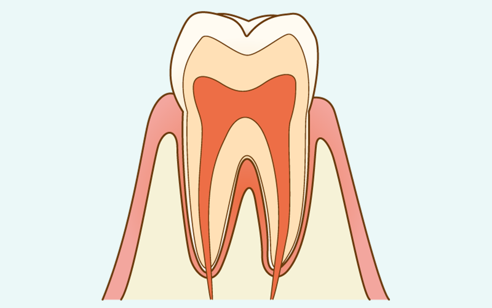 C0（初期虫歯）