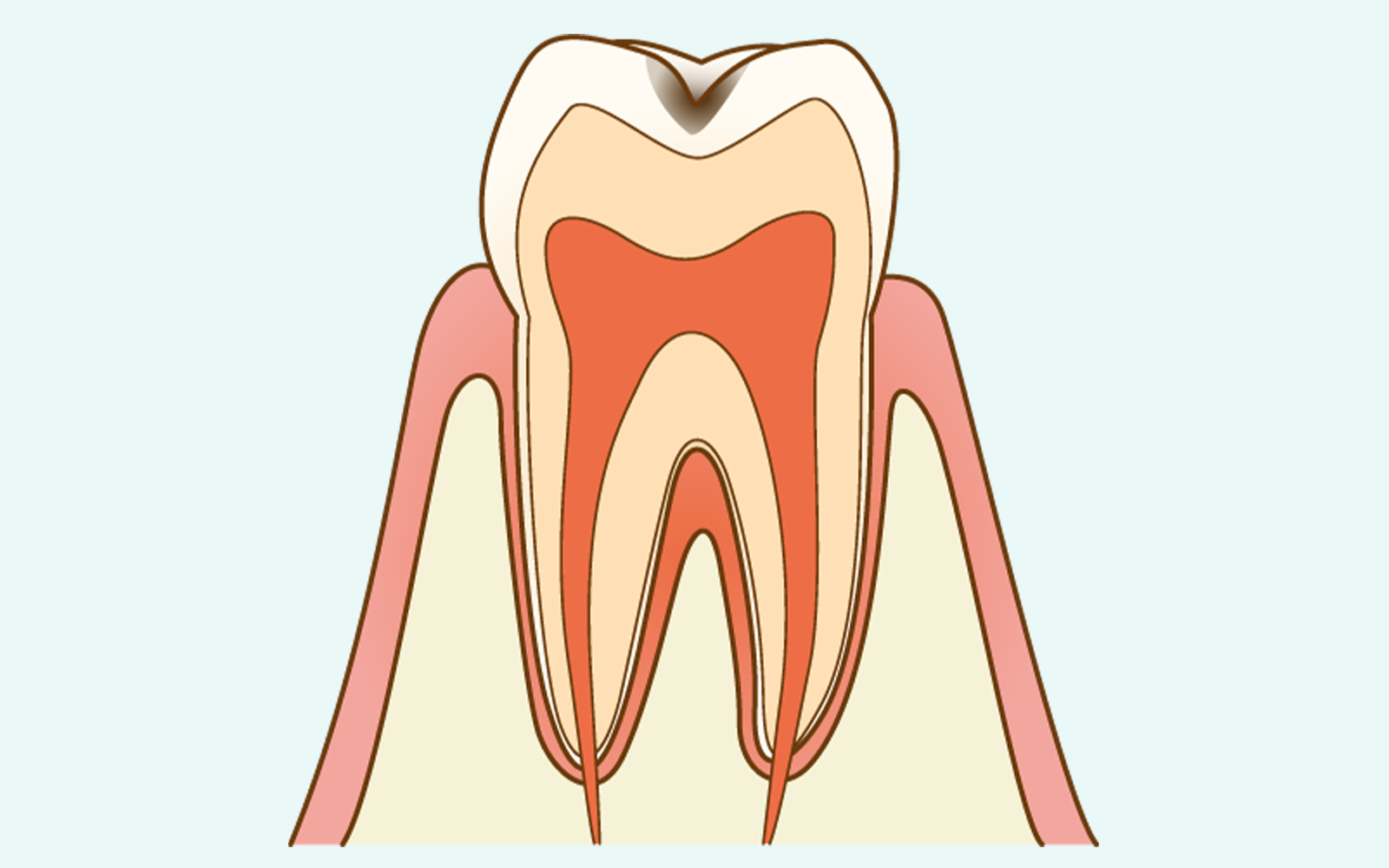 C1（エナメル質の虫歯）