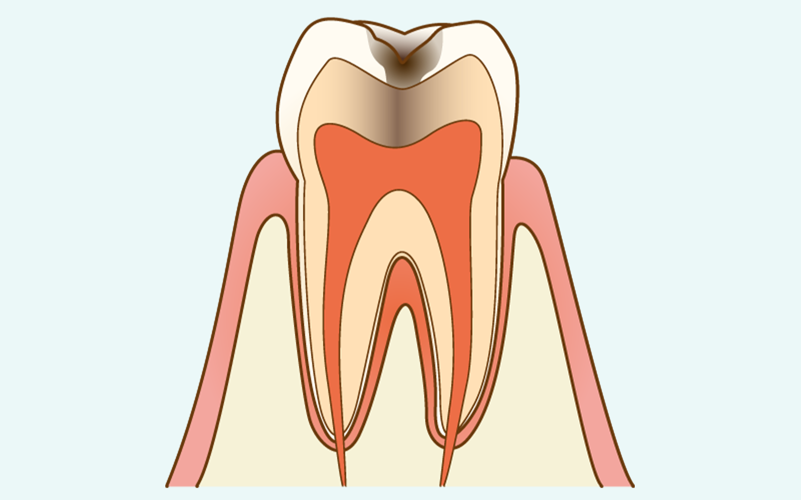 C2（象牙質の虫歯）