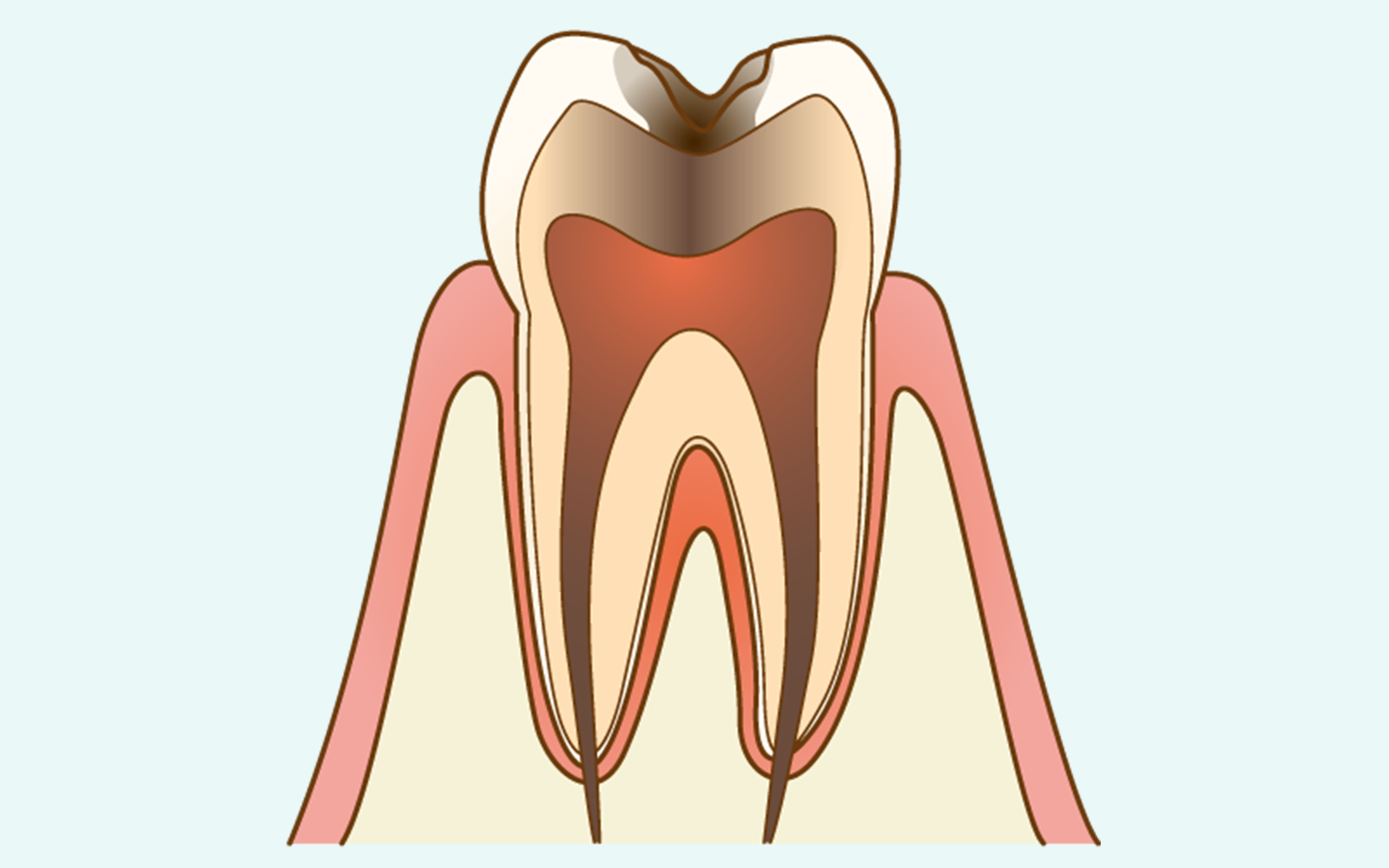 C3（神経まで達した虫歯）