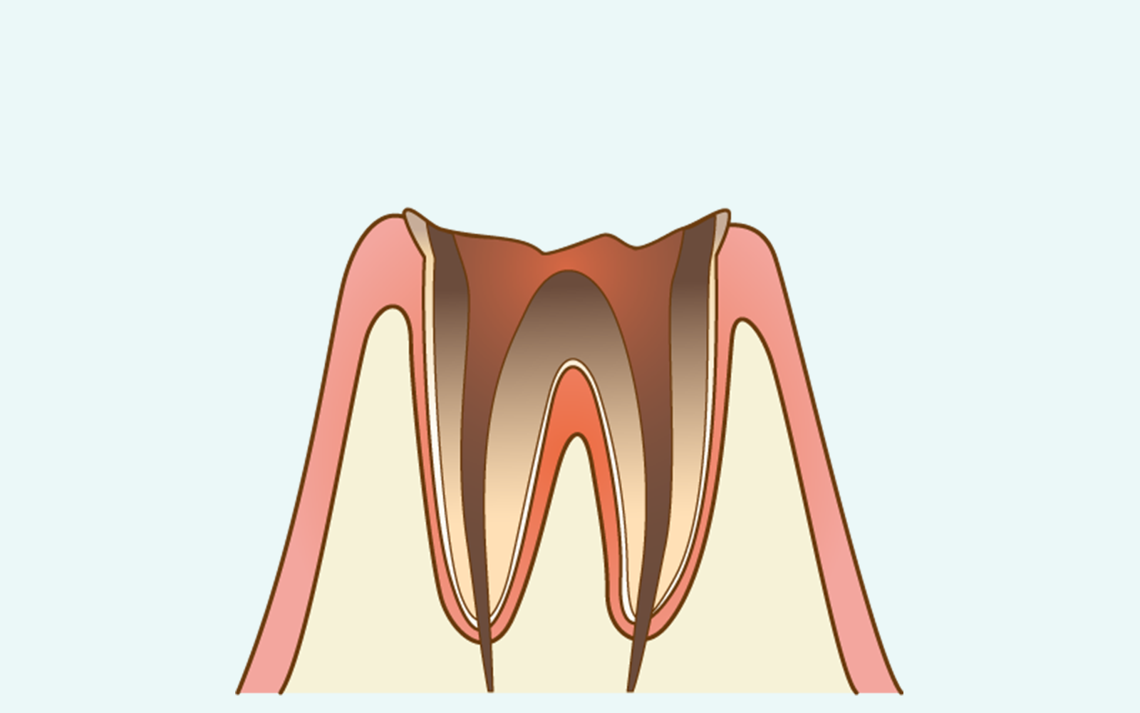 C4（歯根まで達した虫歯）
