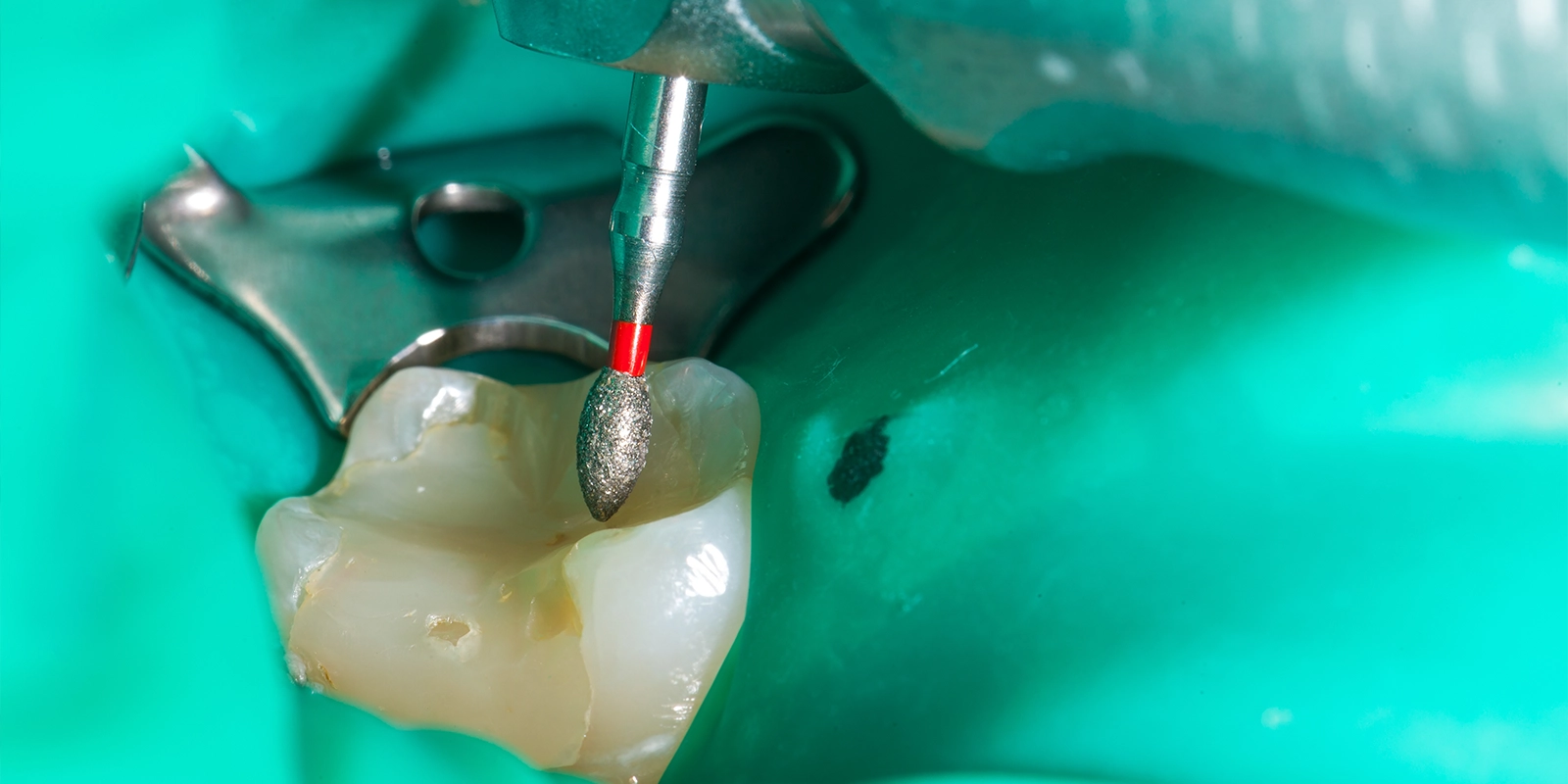 当院の虫歯治療における4つのこだわり