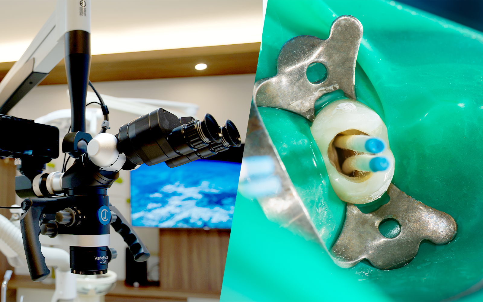 根管治療が必要な場合はマイクロスコープで精密処置