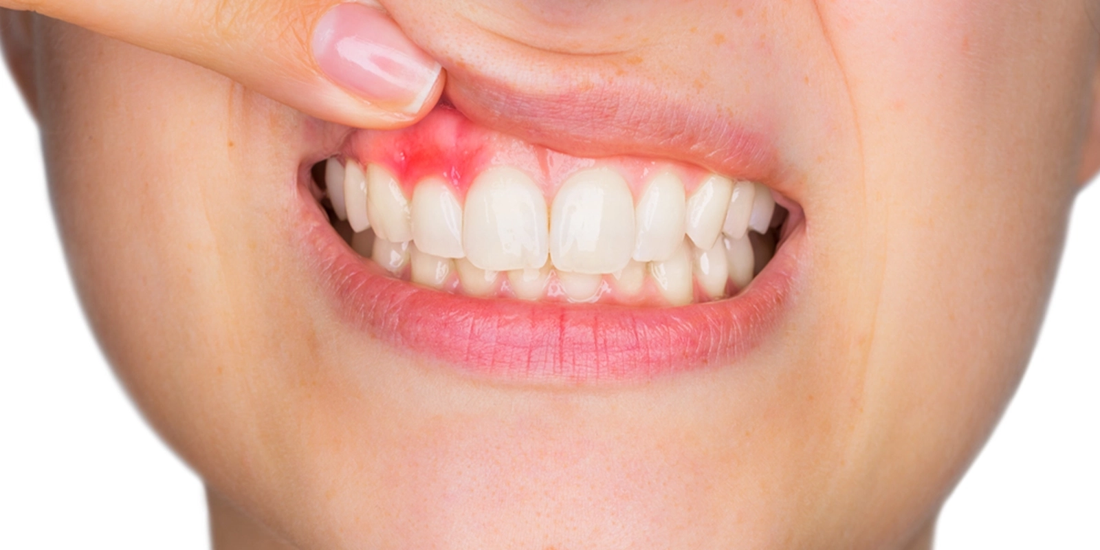 歯周病が進行する仕組みと、なぜ自覚症状が出にくいのか