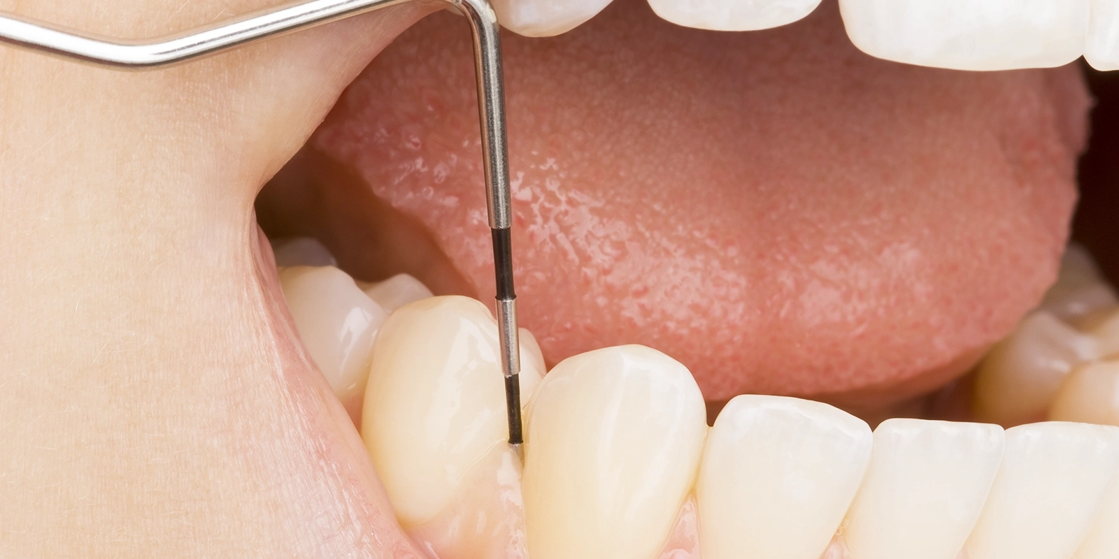 歯周組織検査とスケーリング