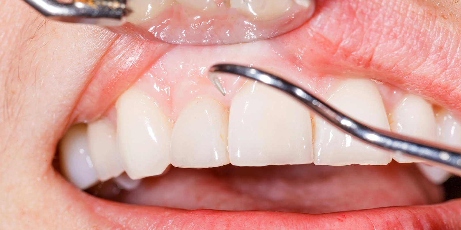 再検査と追加スケーリング