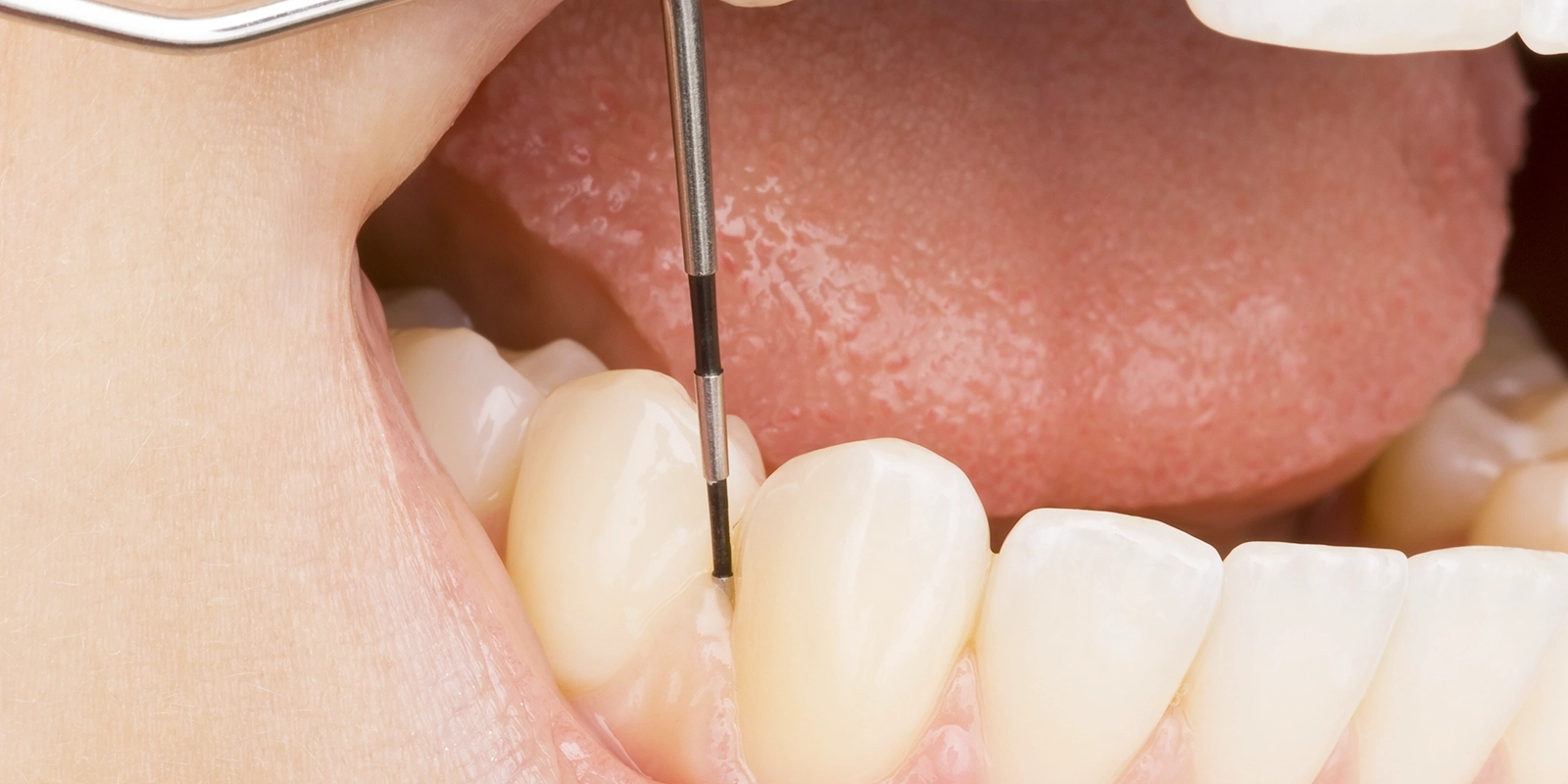 唾液検査・歯周病検査