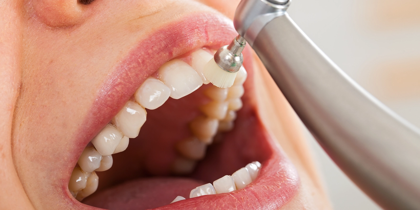 初期治療（スケーリング・PMTC・ブラッシング指導）