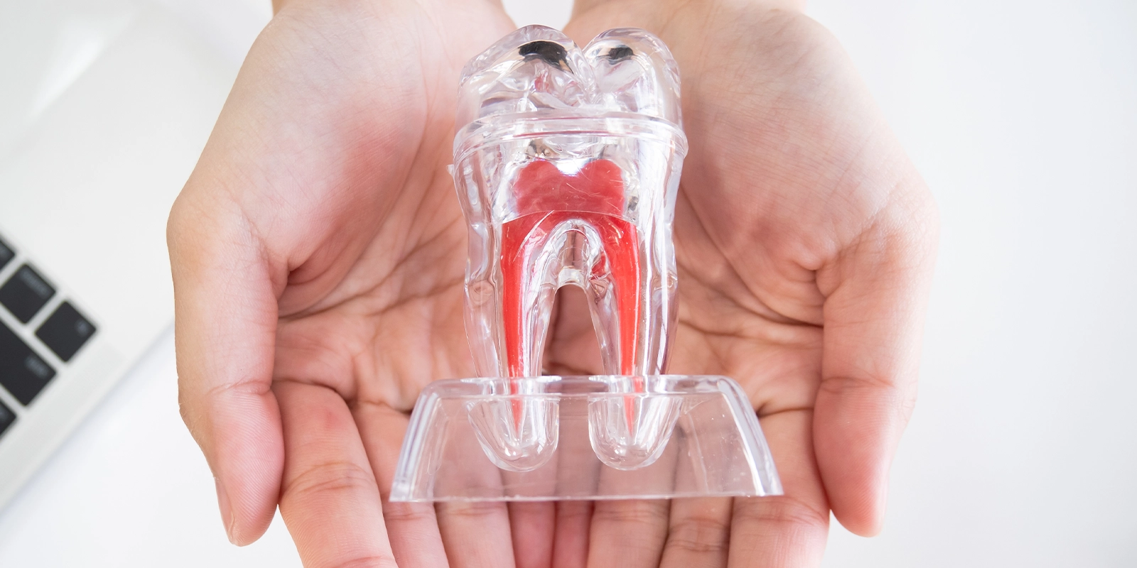 根管治療は「歯を残す」ための最後の砦