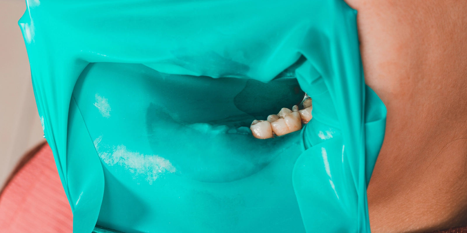 ラバーダムの装着