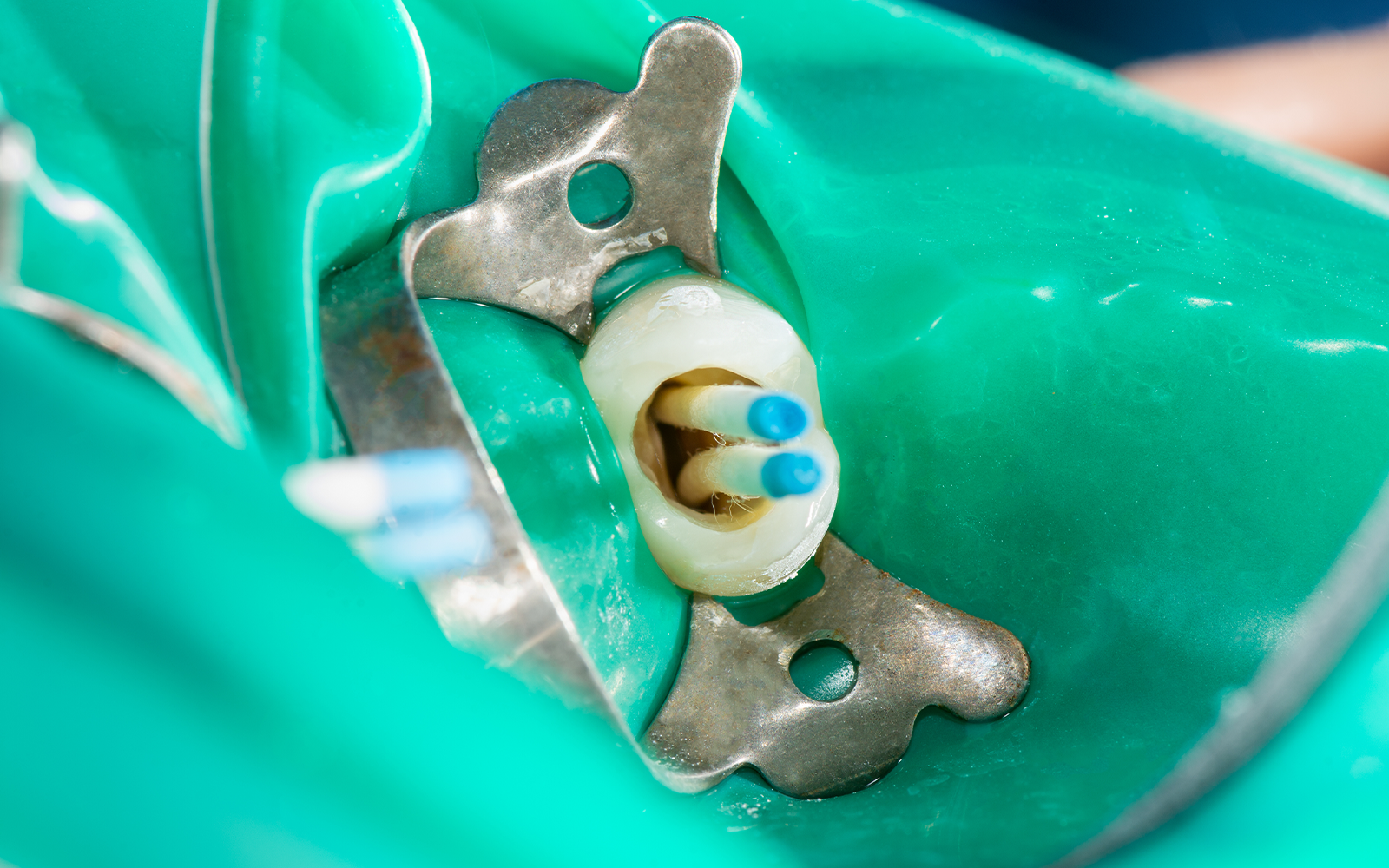 ラバーダムで治療中の無菌環境を確保する