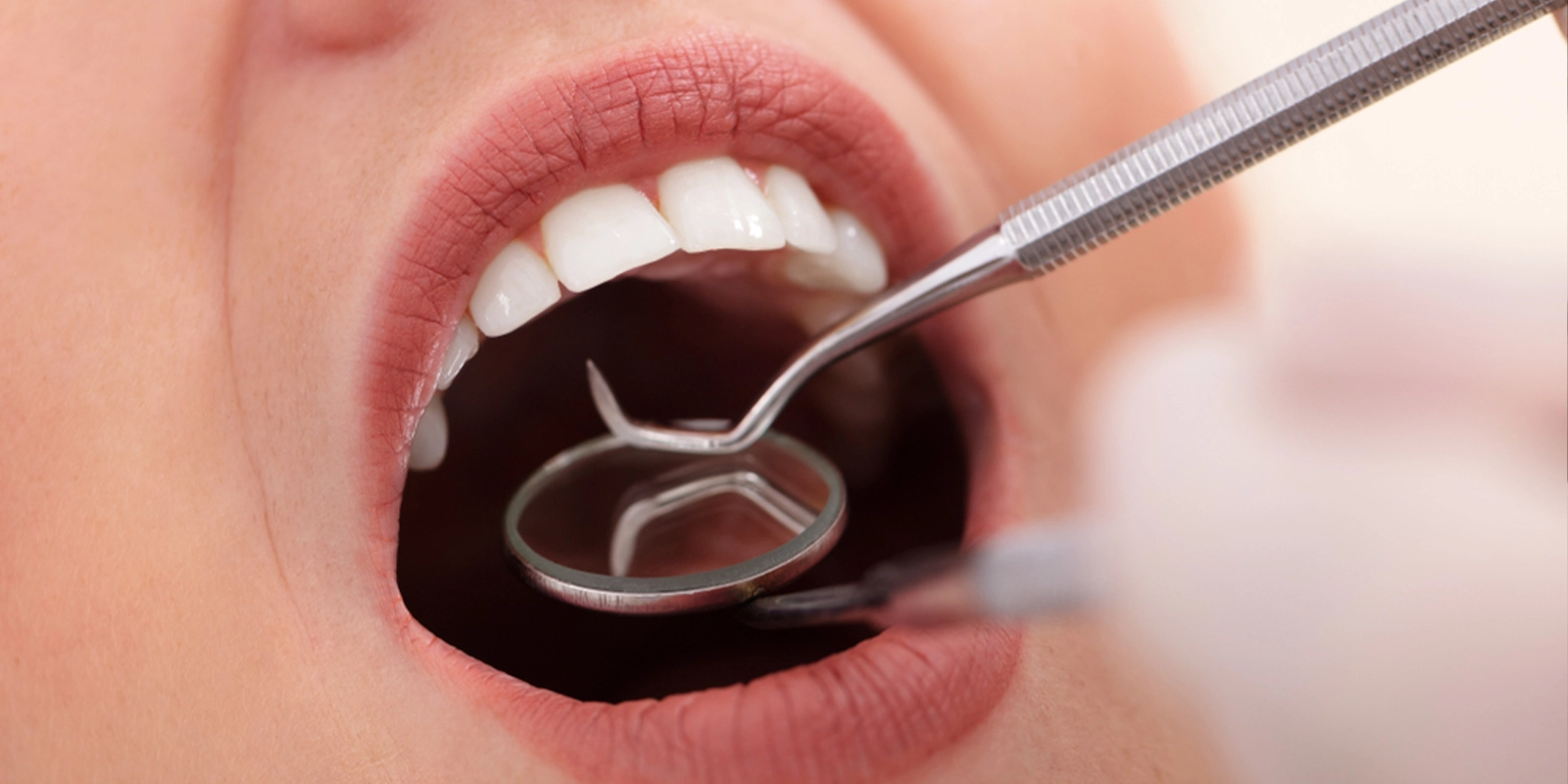 通常の虫歯治療に回数がかかる理由と、短期集中治療で解決できること