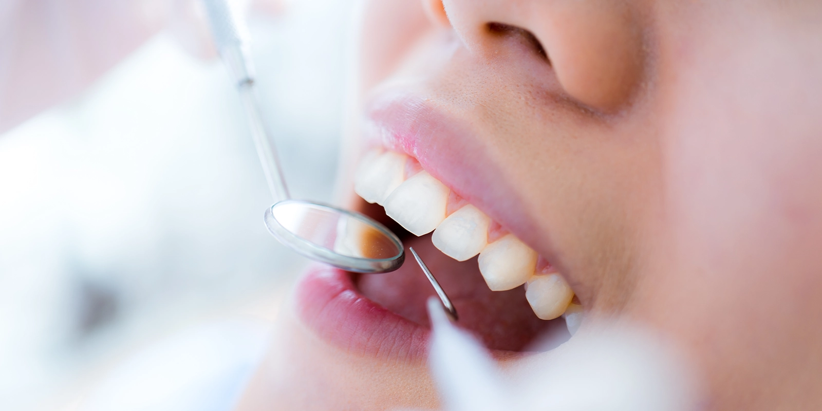 当院の短期集中虫歯治療における3つのアプローチ