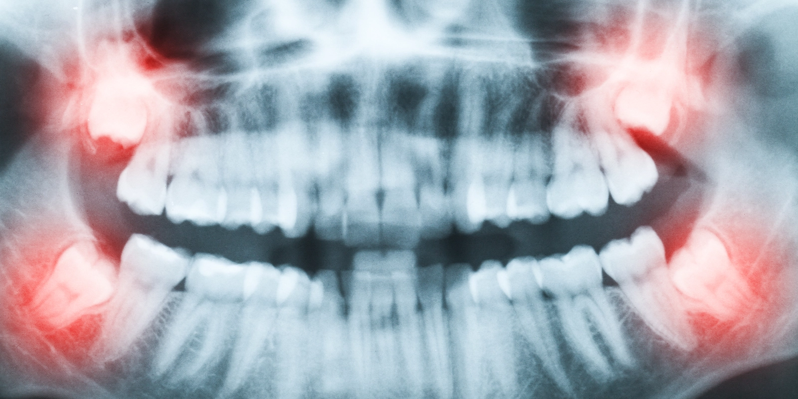 親知らずが痛みや腫れを引き起こす仕組み