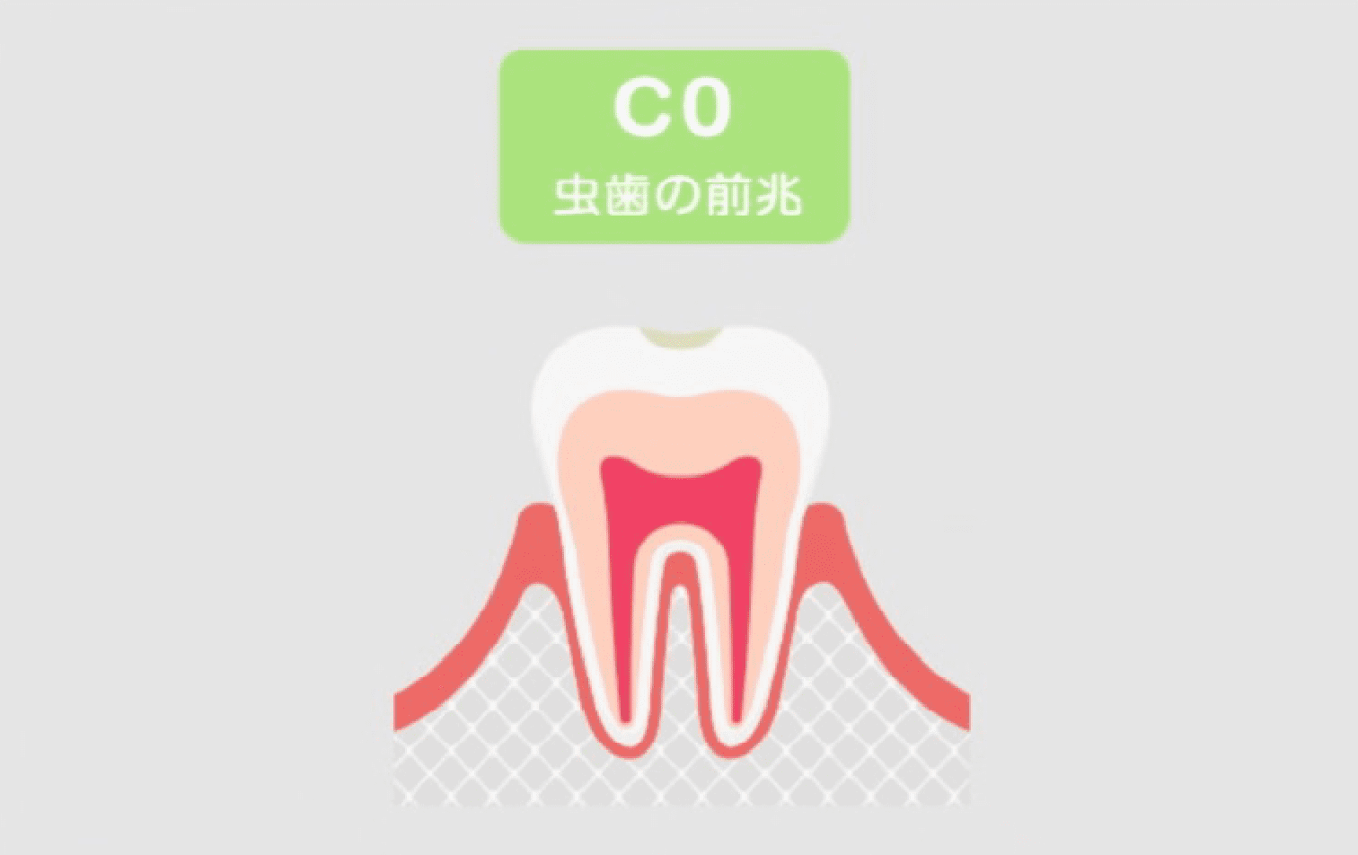 Co(初期虫歯)