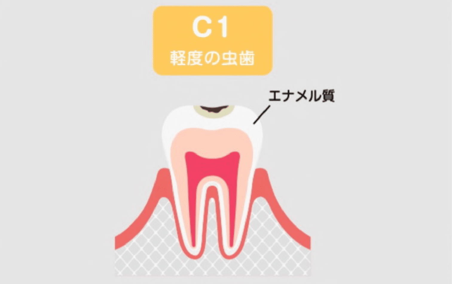 C1(エナメル質の虫歯)