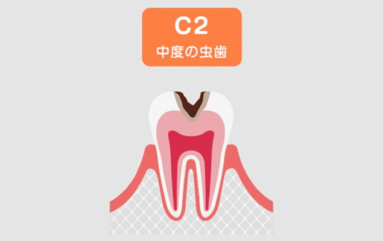 C2(象牙質の虫歯)