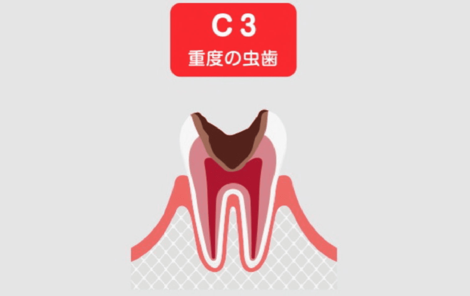 C3(神経まで達した虫歯)
