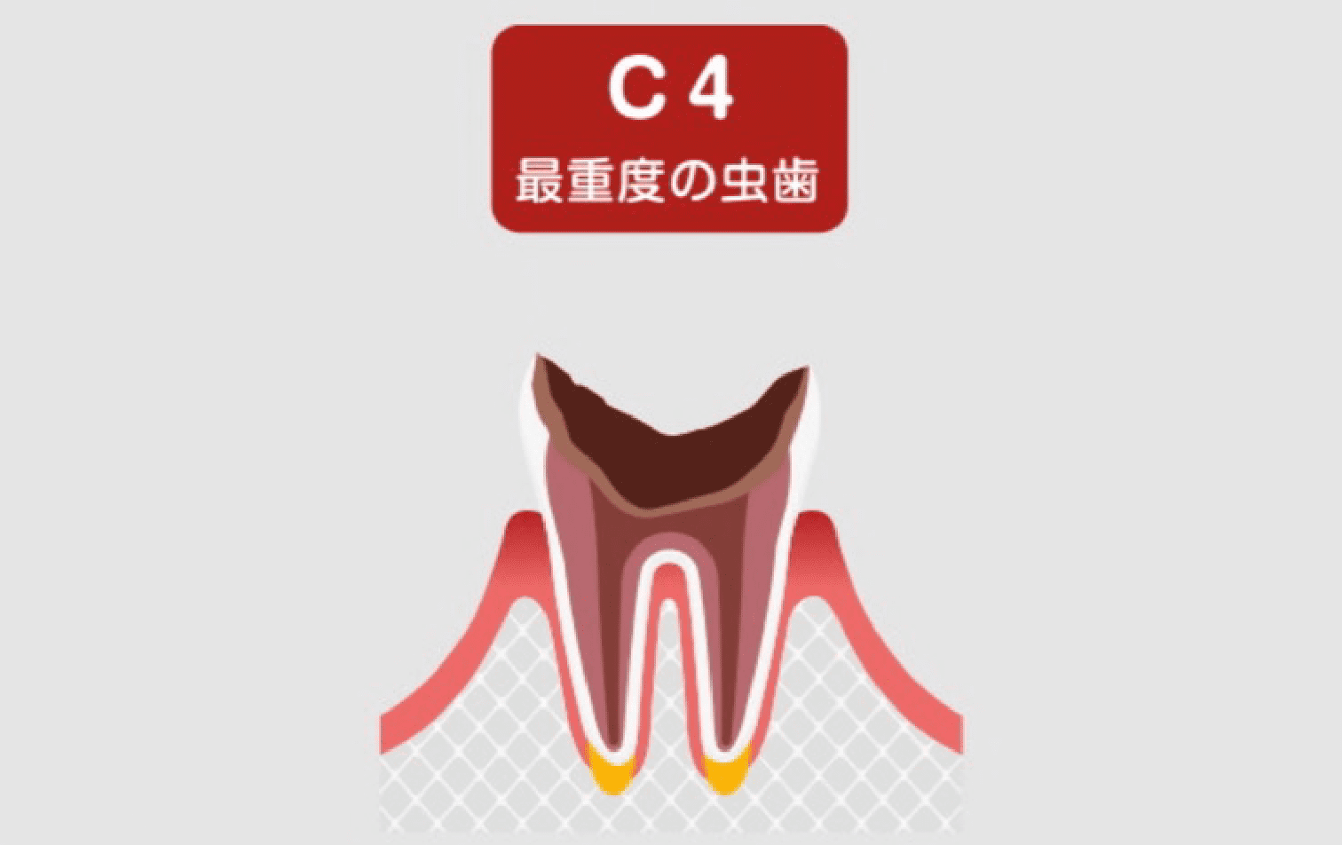 C4(歯根まで達した虫歯)